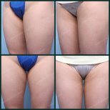 Fotos vor und nach Fettabsaugung durch Dr. 