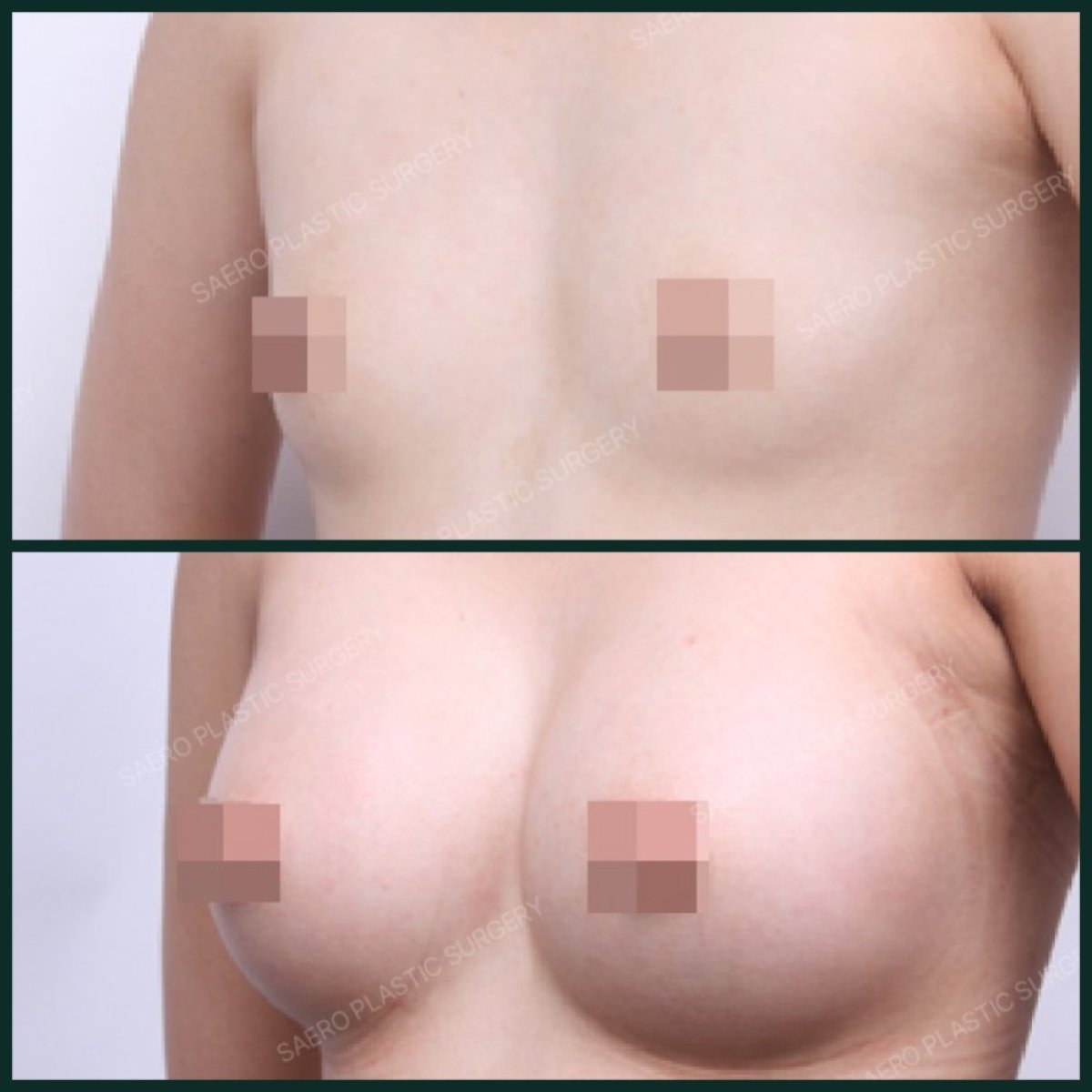 Efekty przed i po powiększeniu piersi w SAERO Plastic Surgery, większa objętość biustu