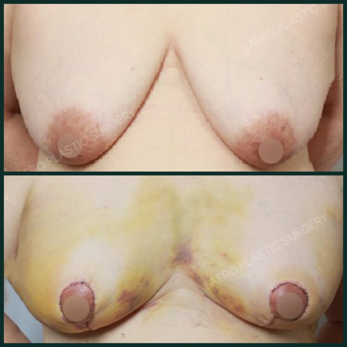 Efekty przed i po redukcji piersi w SAERO Plastic Surgery, poprawiony kształt piersi