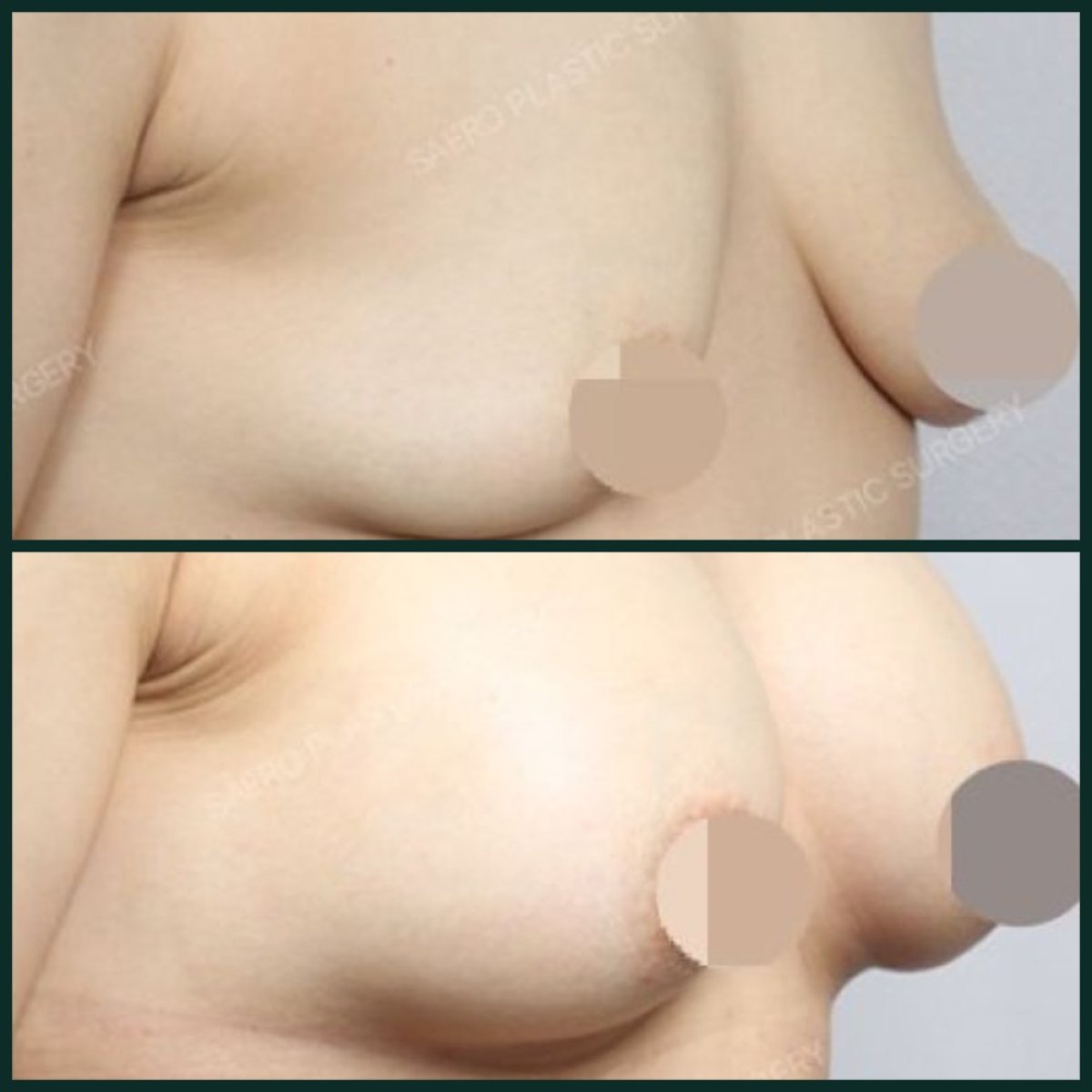 Avant et après augmentation mammaire par lipofilling chez SAERO Plastic Surgery, résultat visible