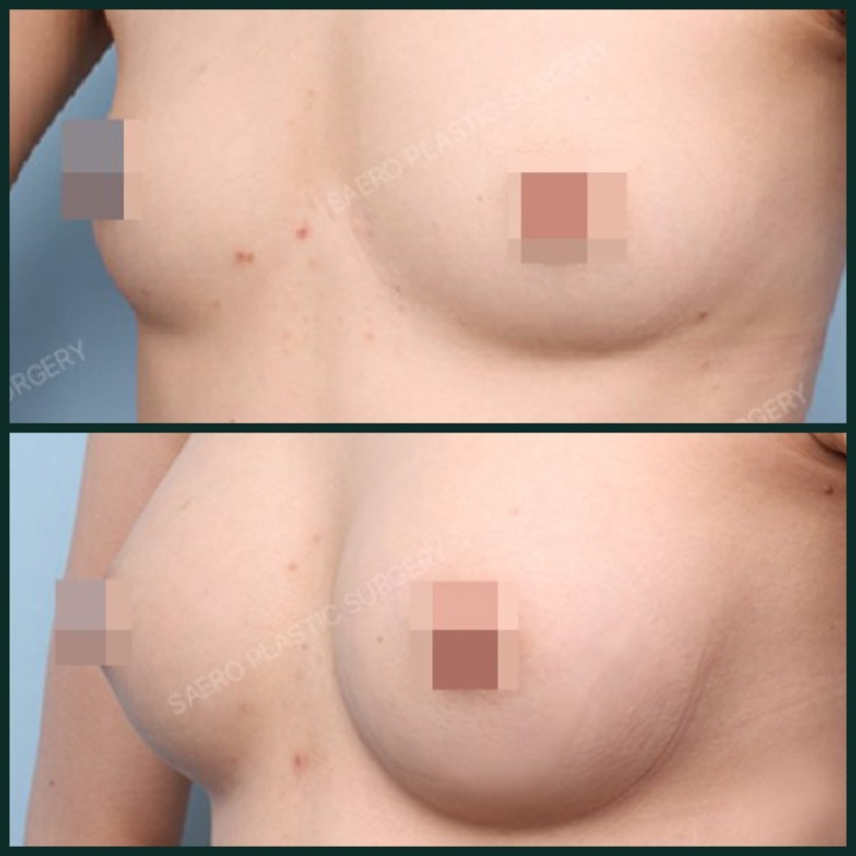 До та після збільшення грудей ліпофілінгом у SAERO Plastic Surgery, помітний результат