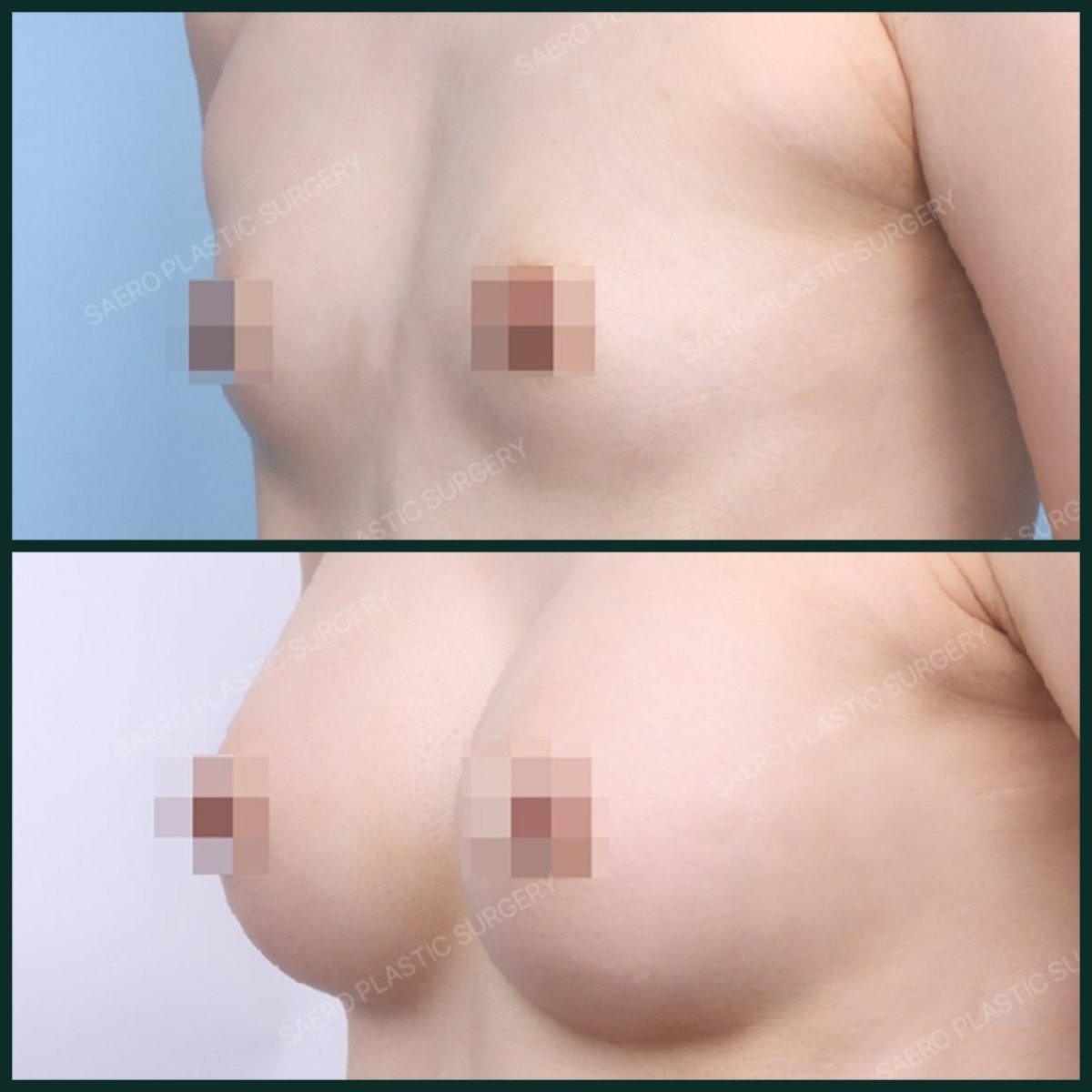 Before and after breast augmentation with fat transfer at SAERO Plastic Surgery, visible results