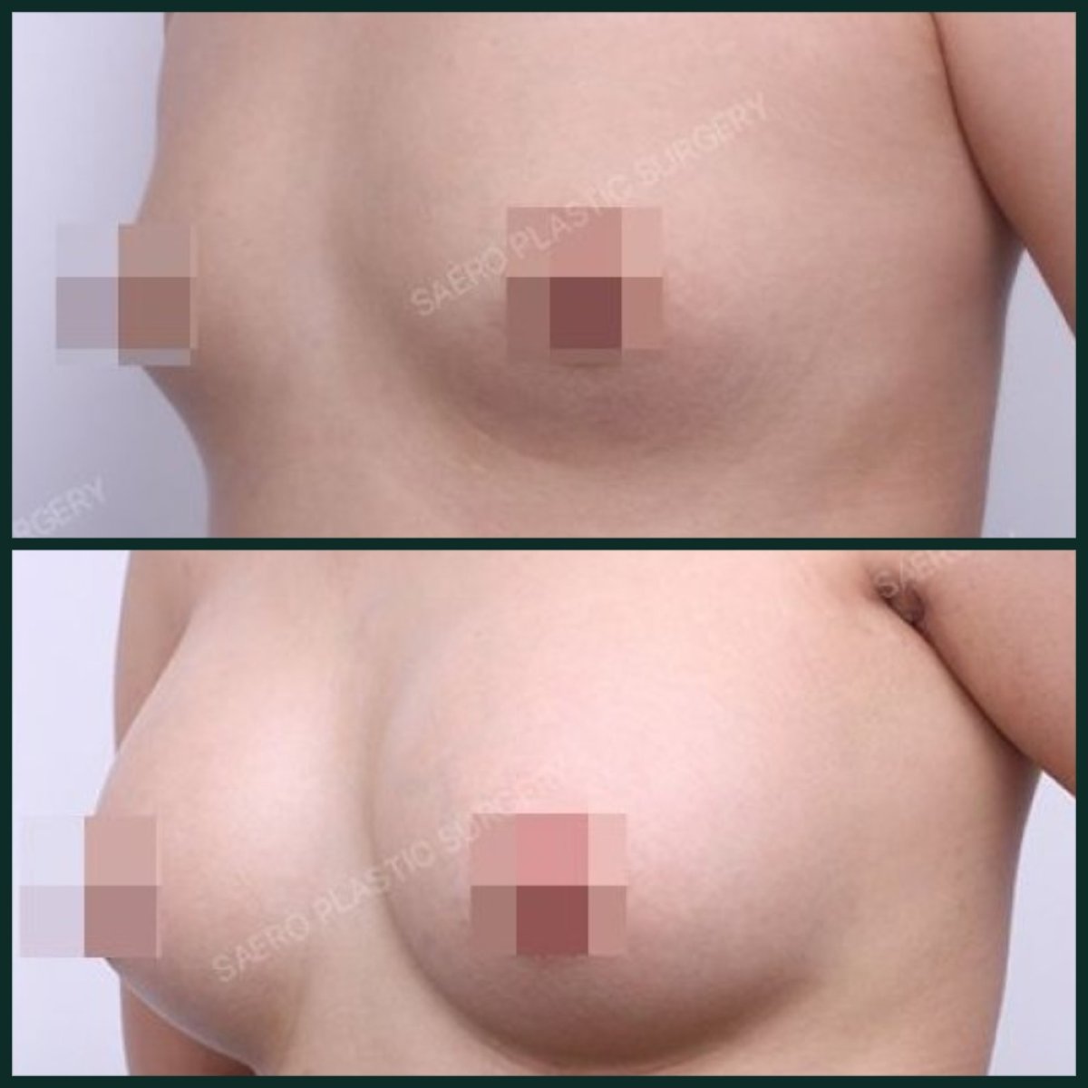 قبل وبعد تكبير الثدي بحقن الدهون في SAERO Plastic Surgery، نتائج واضحة