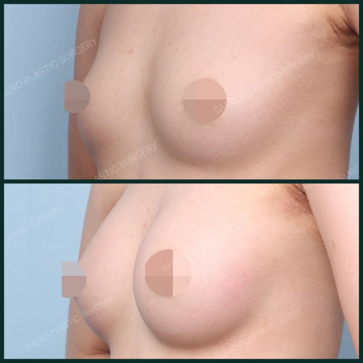 До и после увеличения груди липофилингом в SAERO Plastic Surgery, видимый результат