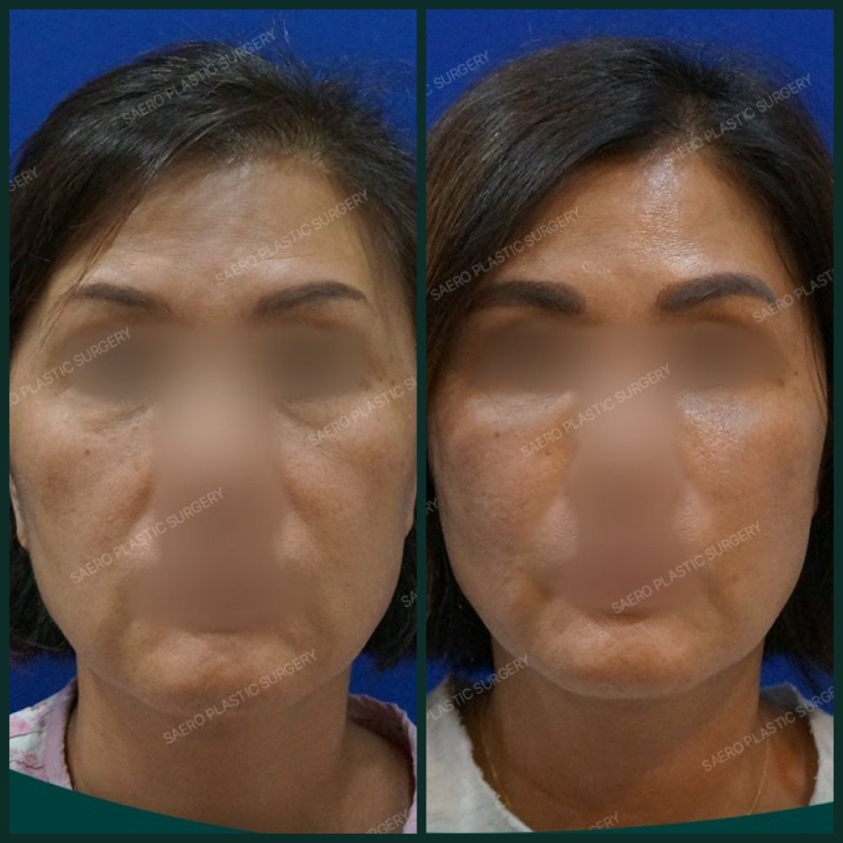 Résultats avant/après lifting des sourcils chez SAERO Plastic Surgery, sourcils relevés