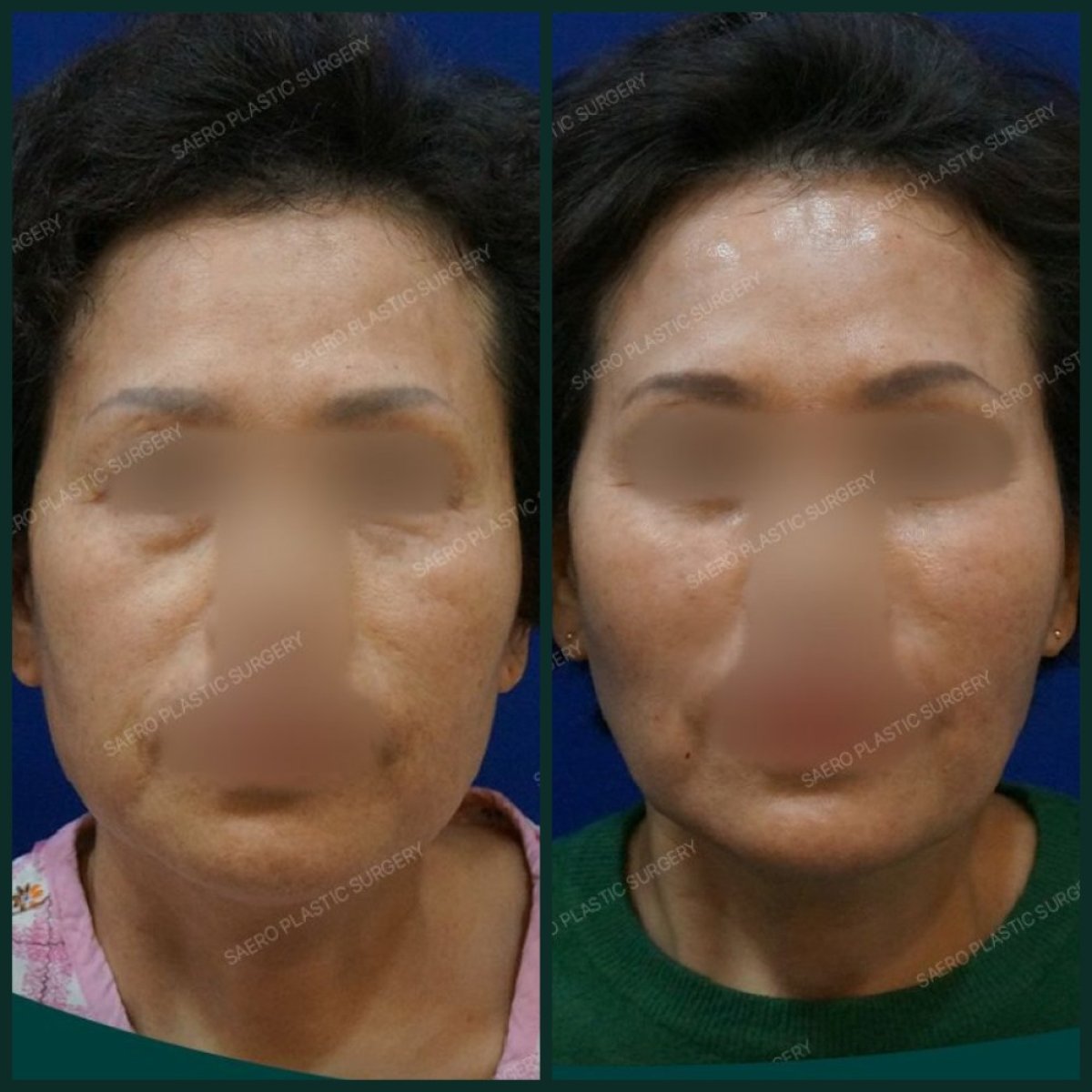Résultats avant et après lifting des sourcils chez SAERO Plastic Surgery, rajeunissement du front