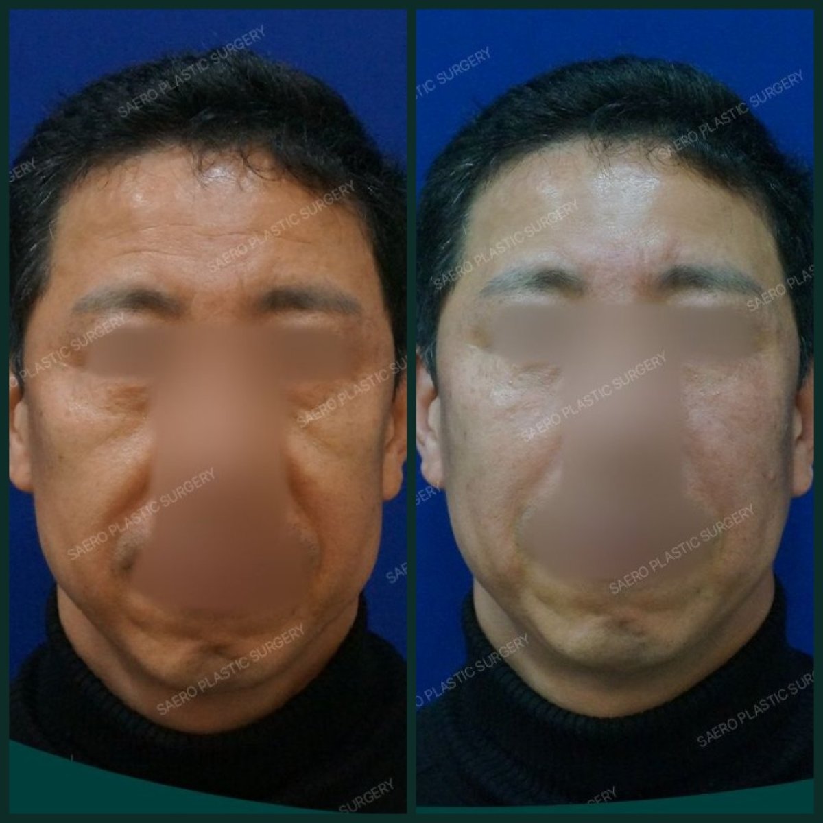 Результаты подтяжки бровей до и после в SAERO Plastic Surgery, видимый лифтинг лба