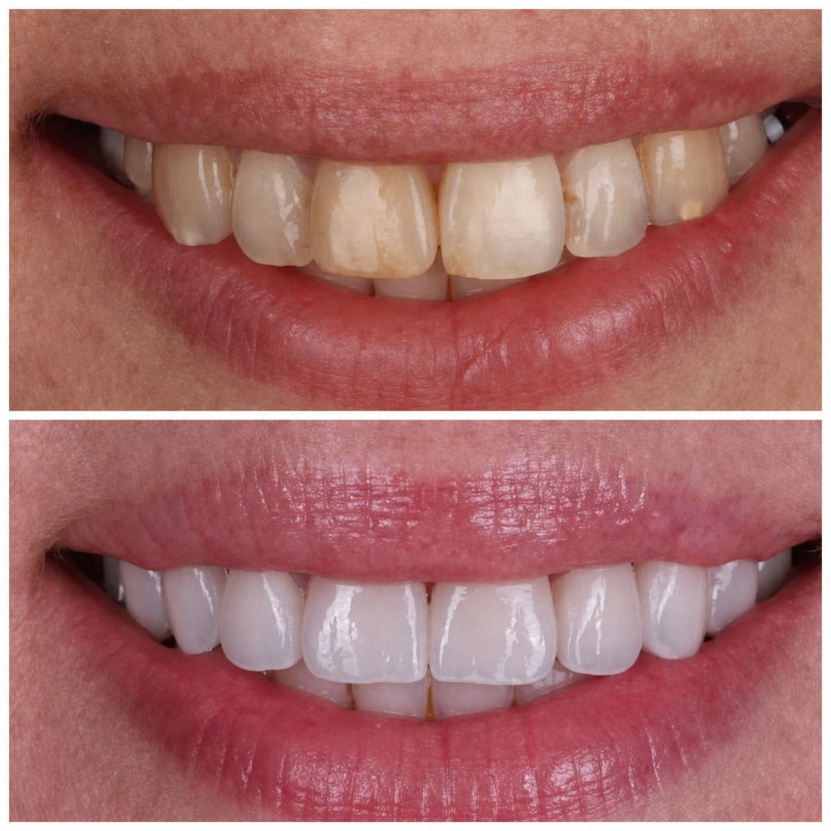 Результаты до и после установки виниров в Dental Clinic Dynasty Stomatology в Кракове