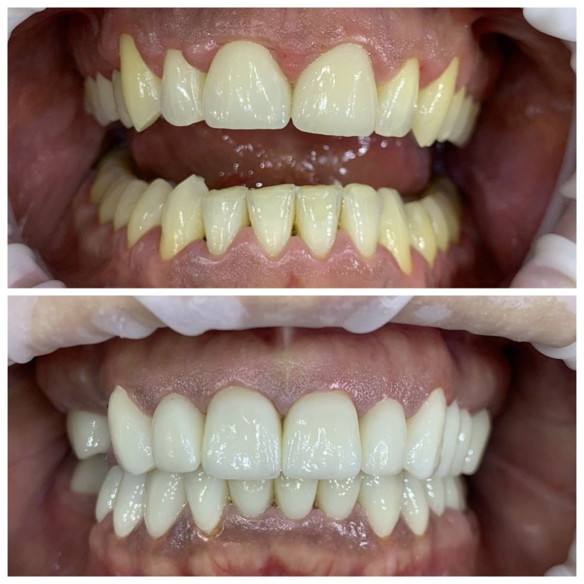 Resultados antes y después de Hollywood Smile en Smile Terminal Dental Care, transformación con carillas