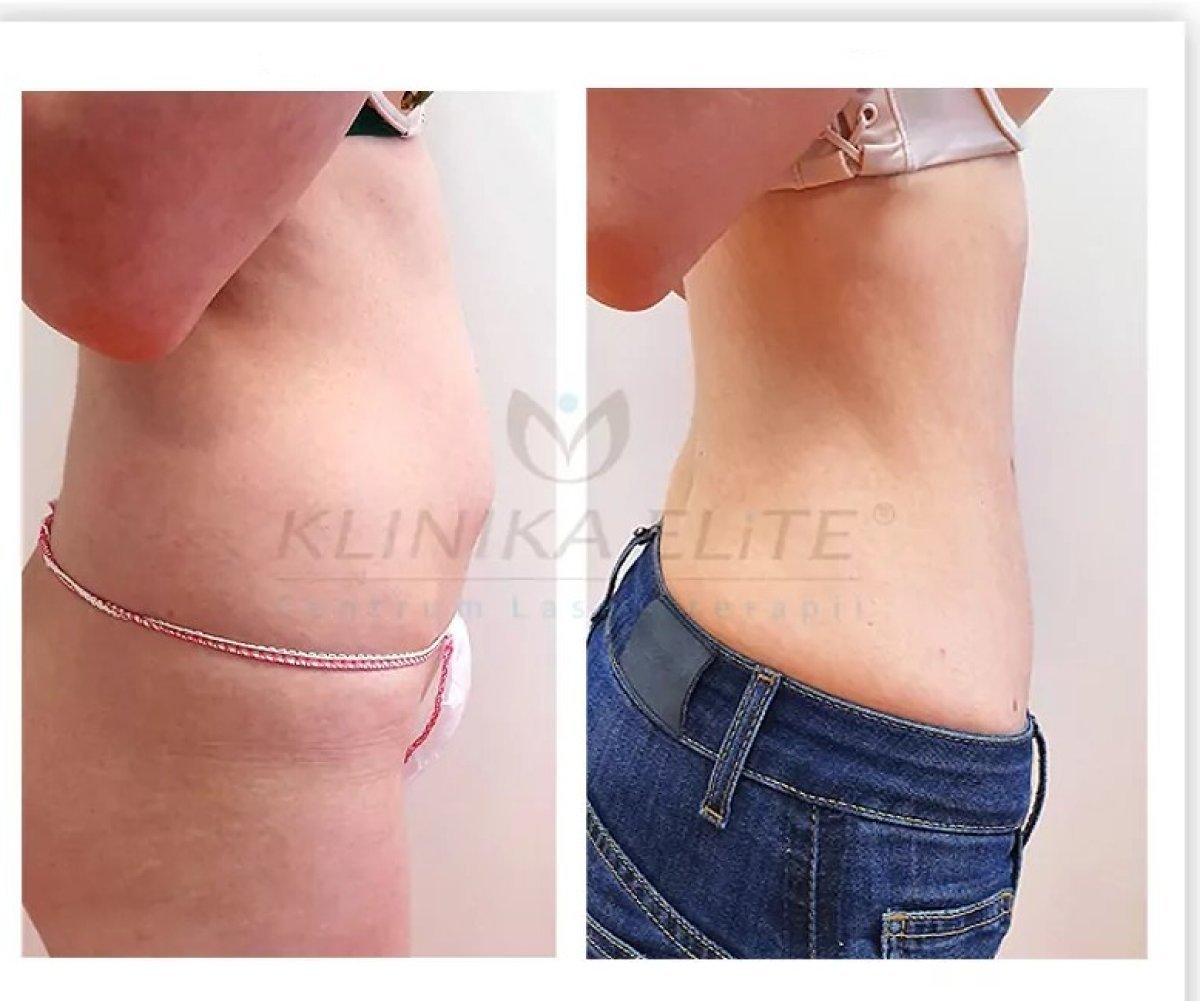 Before and after liposuction results at Klinika Elite Centrum Laseroterapii, slimmer abdomen