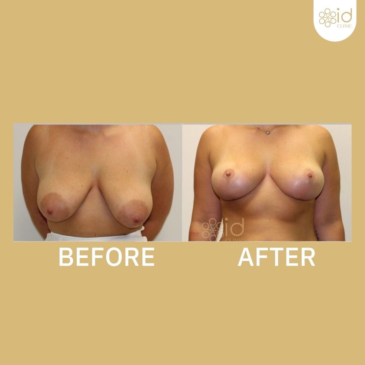 Before and after breast lift results at ID Clinic Bangkok, improved breast shape and contour
