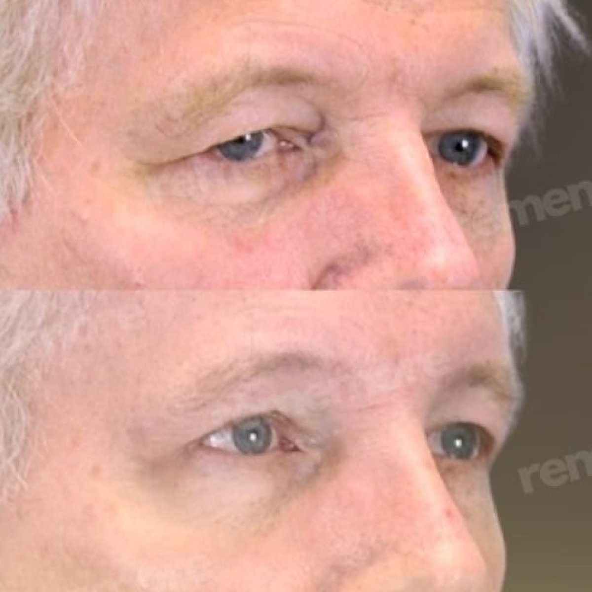 Before and after lower eyelid blepharoplasty results at Memorial Şişli Hospital, rejuvenated look