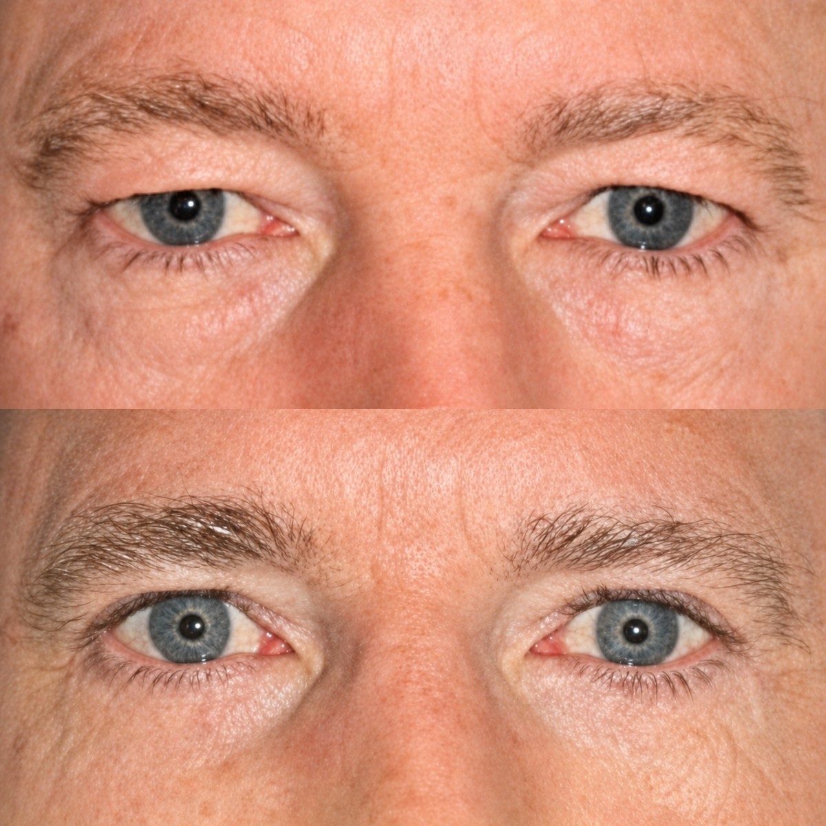 Resultados de blefaroplastia inferior antes y después en Memorial Şişli Hospital, ojos rejuvenecidos