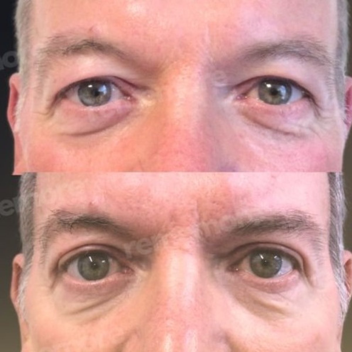 Before and after lower eyelid blepharoplasty result at Memorial Şişli Hospital, reduced eye bags