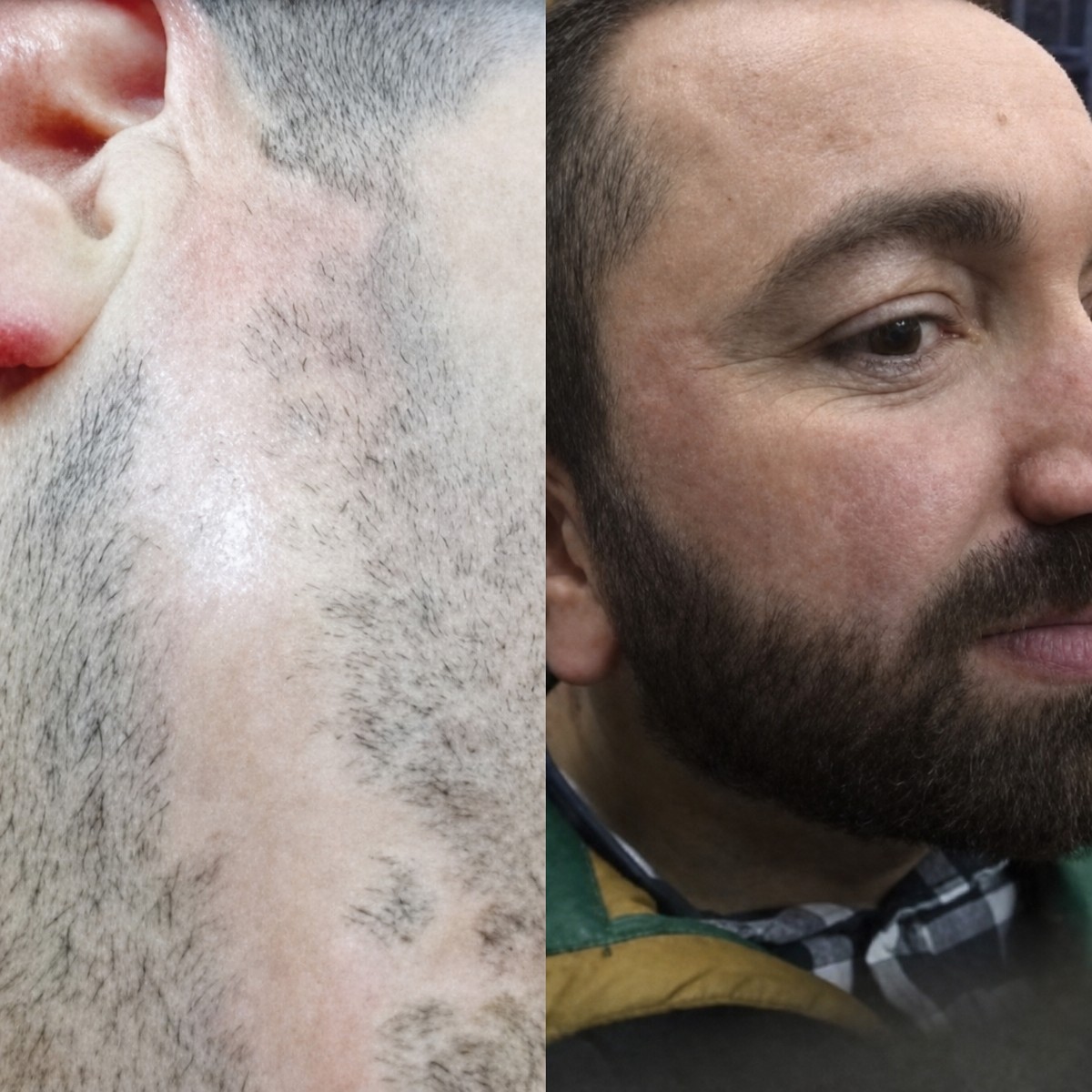 Результаты пересадки бороды до и после в Istanbul Hair Indonesia, густая борода