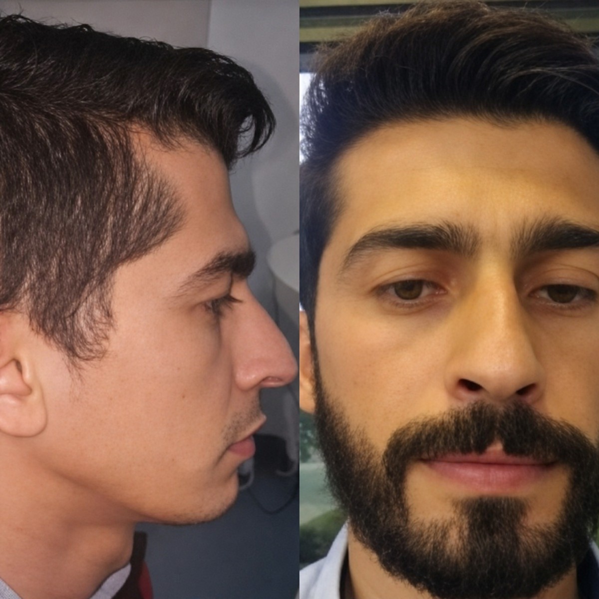 نتائج زراعة اللحية قبل وبعد في Istanbul Hair Indonesia، لحية أكثر كثافة