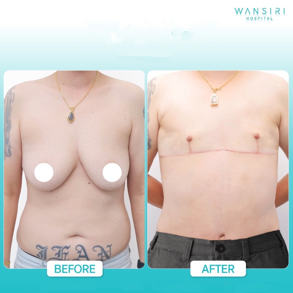 Résultats avant/après top surgery à Wansiri Hospital – masculinisation du torse