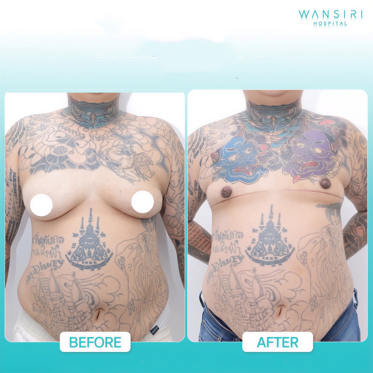 Resultados de top surgery antes y después en Wansiri Hospital, masculinización de pecho