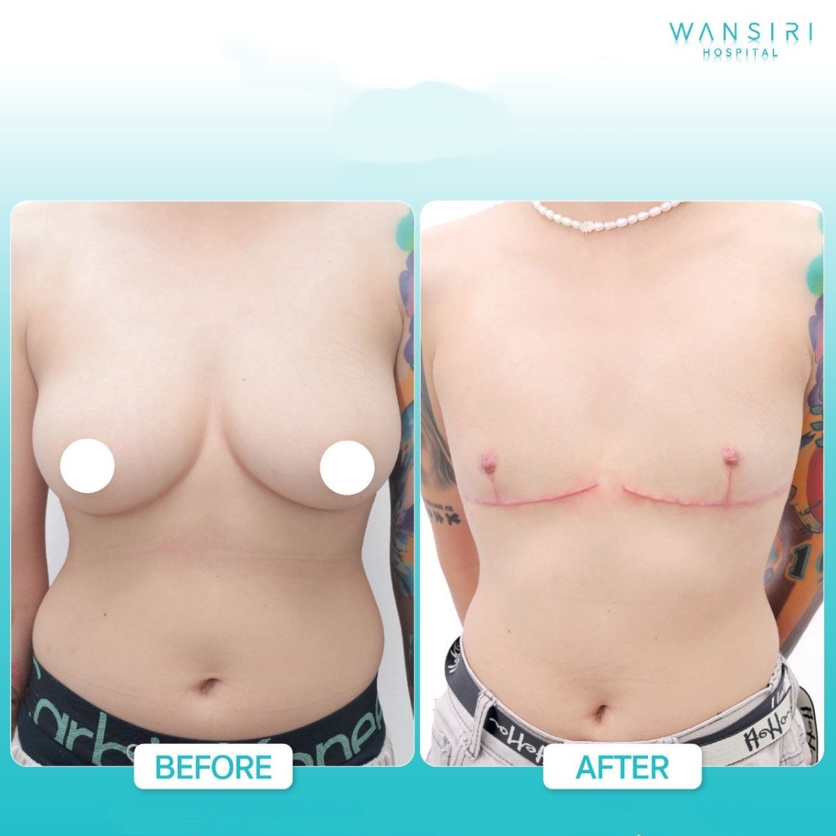 Resultados de top surgery antes y después en Wansiri Hospital, masculinización torácica