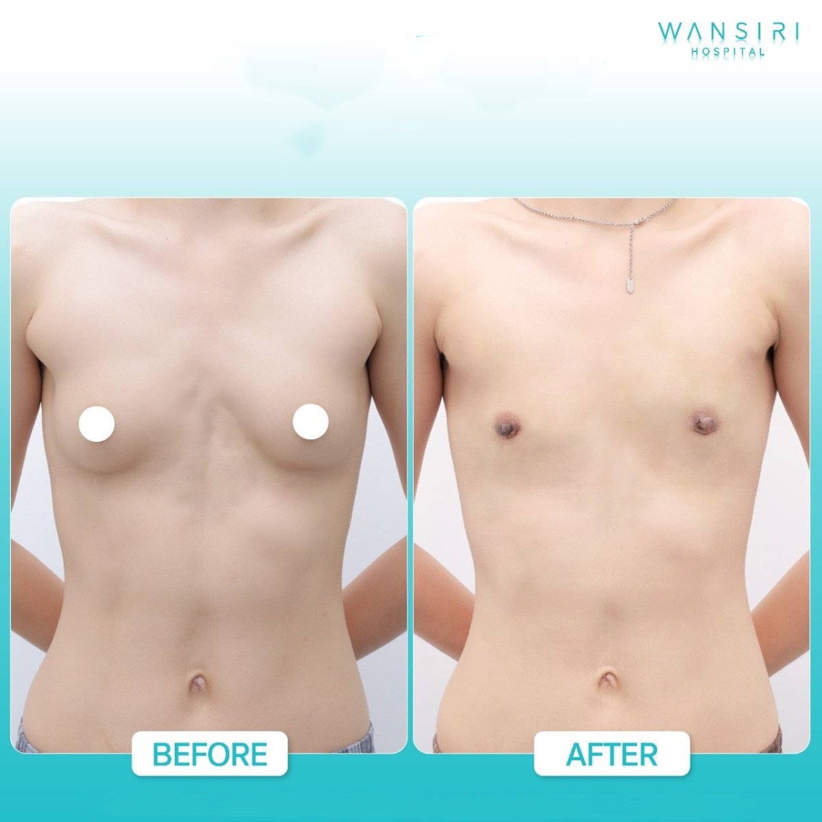 Resultados de top surgery antes y después en Wansiri Hospital, masculinización torácica