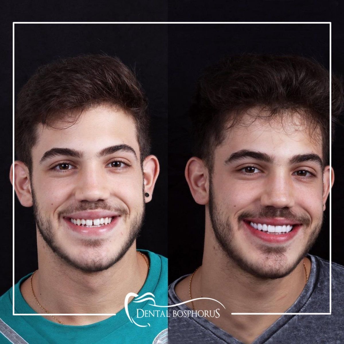 Before and after zirconia crown results at Dental Bosphorus, improved smile aesthetics