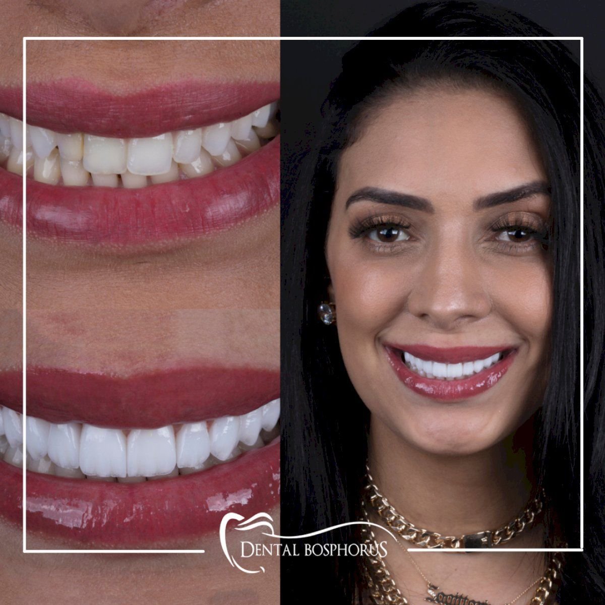 Before and after zirconia crown results at Dental Bosphorus, smile transformation visible