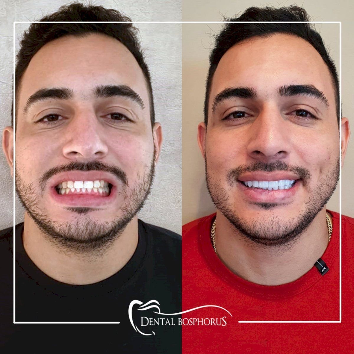 Before and after zirconia crown results at Dental Bosphorus, improved smile aesthetics