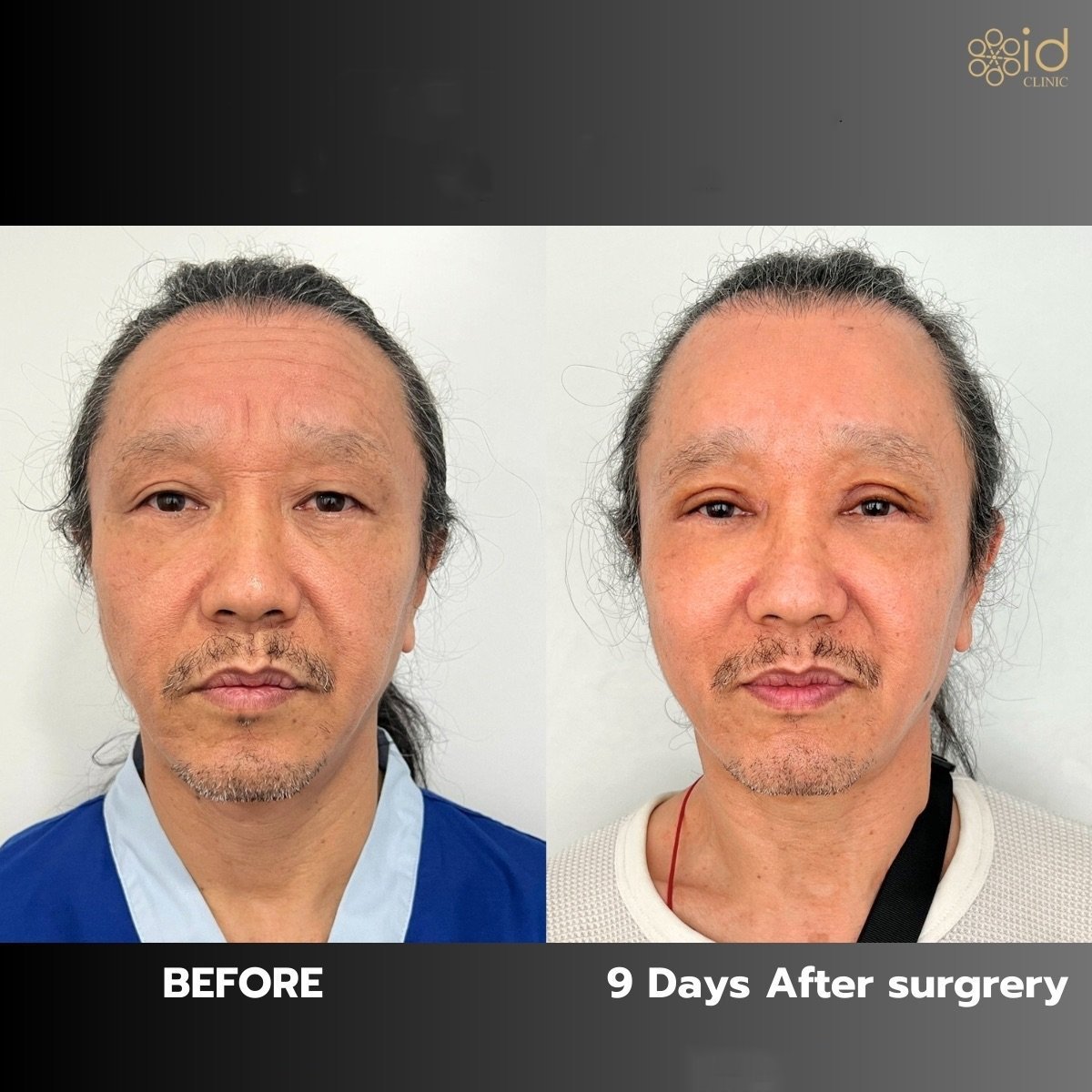 Before and after brow lift results at ID Clinic Bangkok, visible forehead and eye area improvement