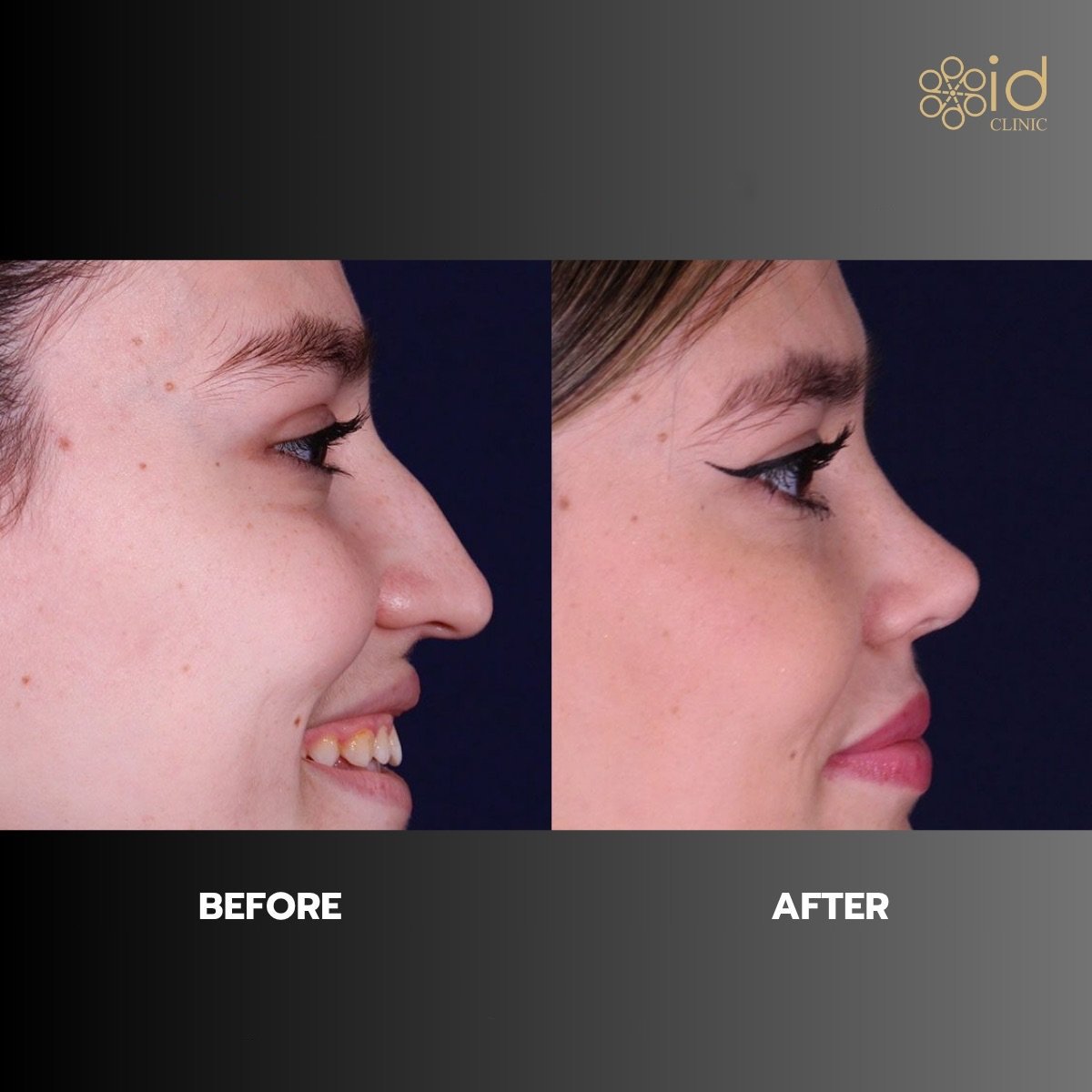 Before and after rhinoplasty results at ID Clinic Bangkok, nose reshaping for improved profile