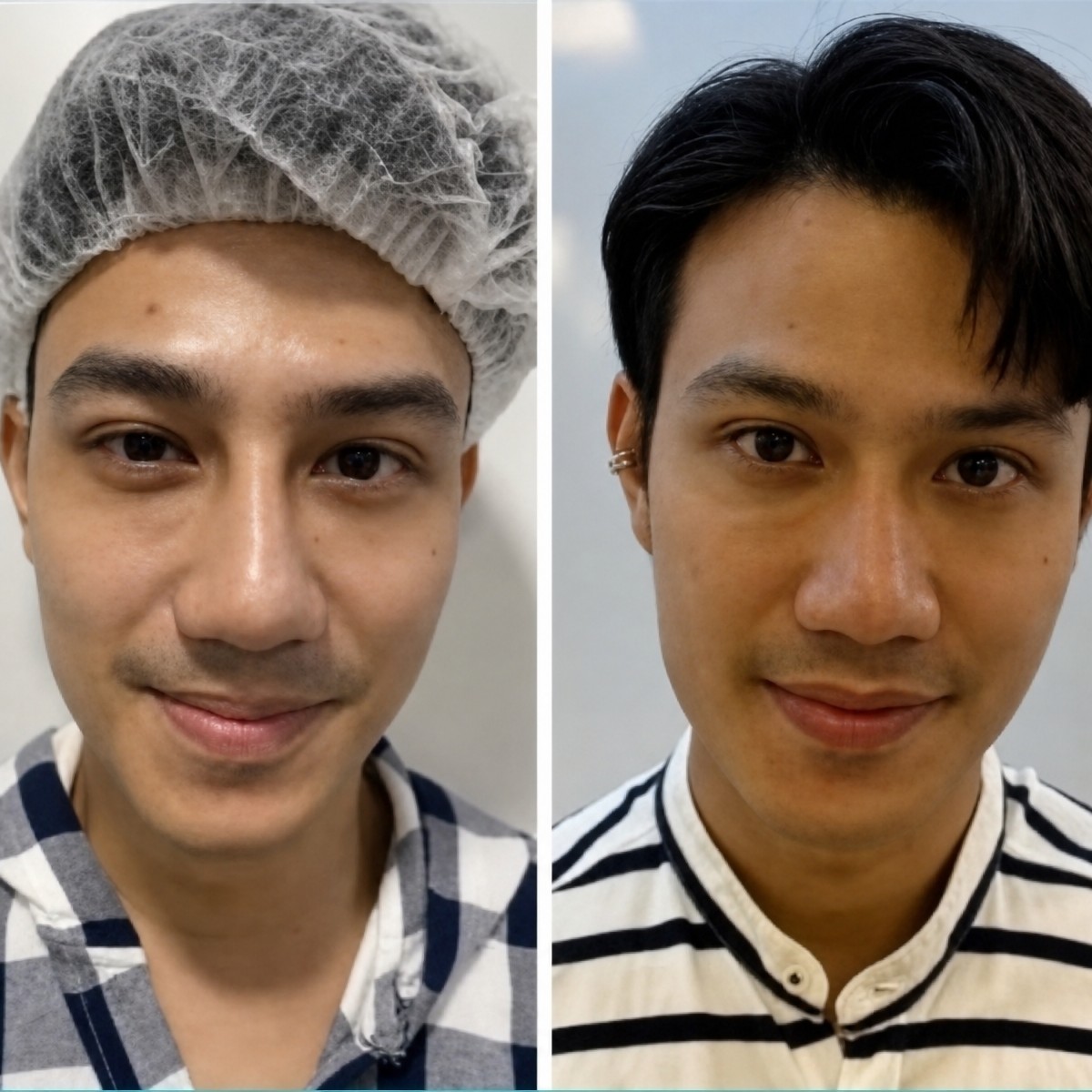 Before and after Asian rhinoplasty result at ID Clinic Bangkok, natural nose reshaping outcome