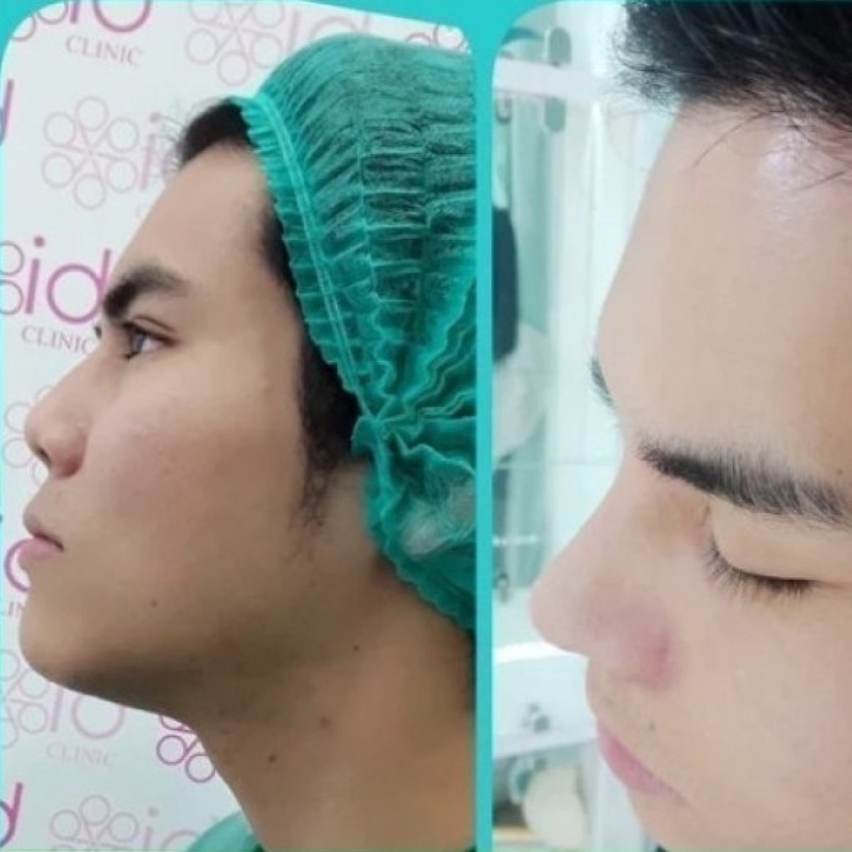 Asian rhinoplasty before and after results at ID Clinic Bangkok, improved nose shape and profile