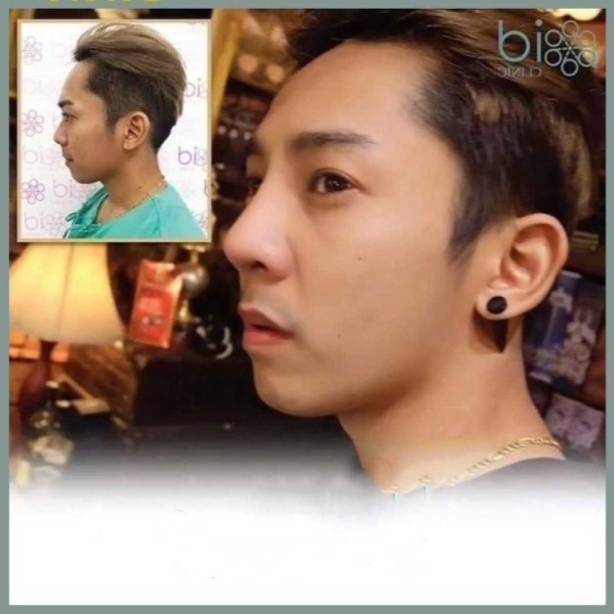 Before and after Asian rhinoplasty results at ID Clinic Bangkok, improved nose profile