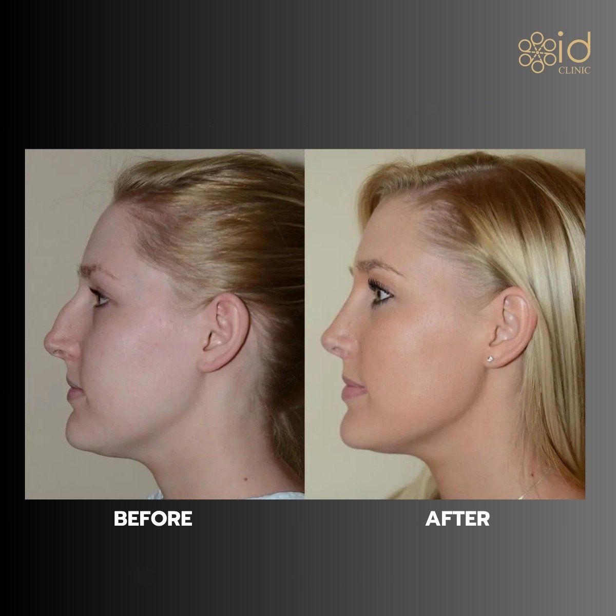 Before and after rhinoplasty results at ID Clinic Bangkok, nose reshaping for natural look