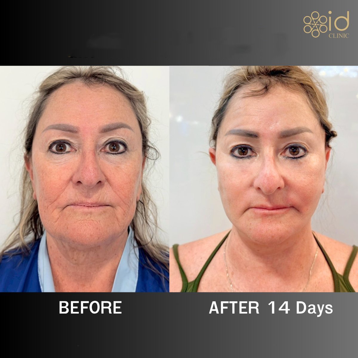 Before and after brow lift results at ID Clinic Bangkok, visible forehead and eye area rejuvenation