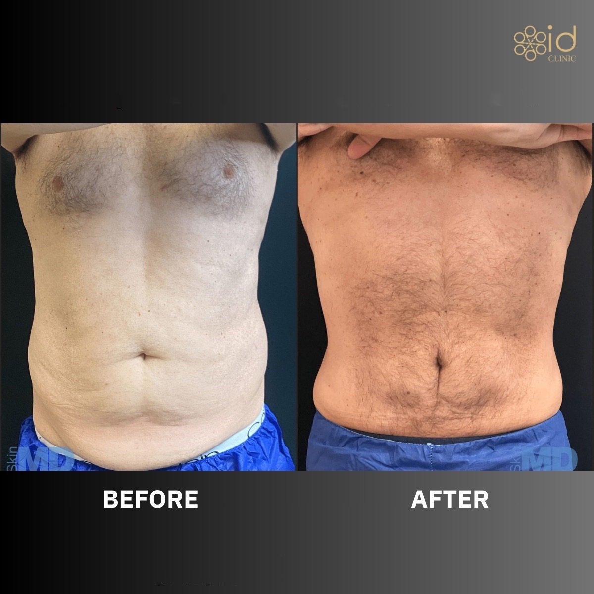 Before and after BodyTite body contouring results at ID Clinic Bangkok, improved abdomen shape