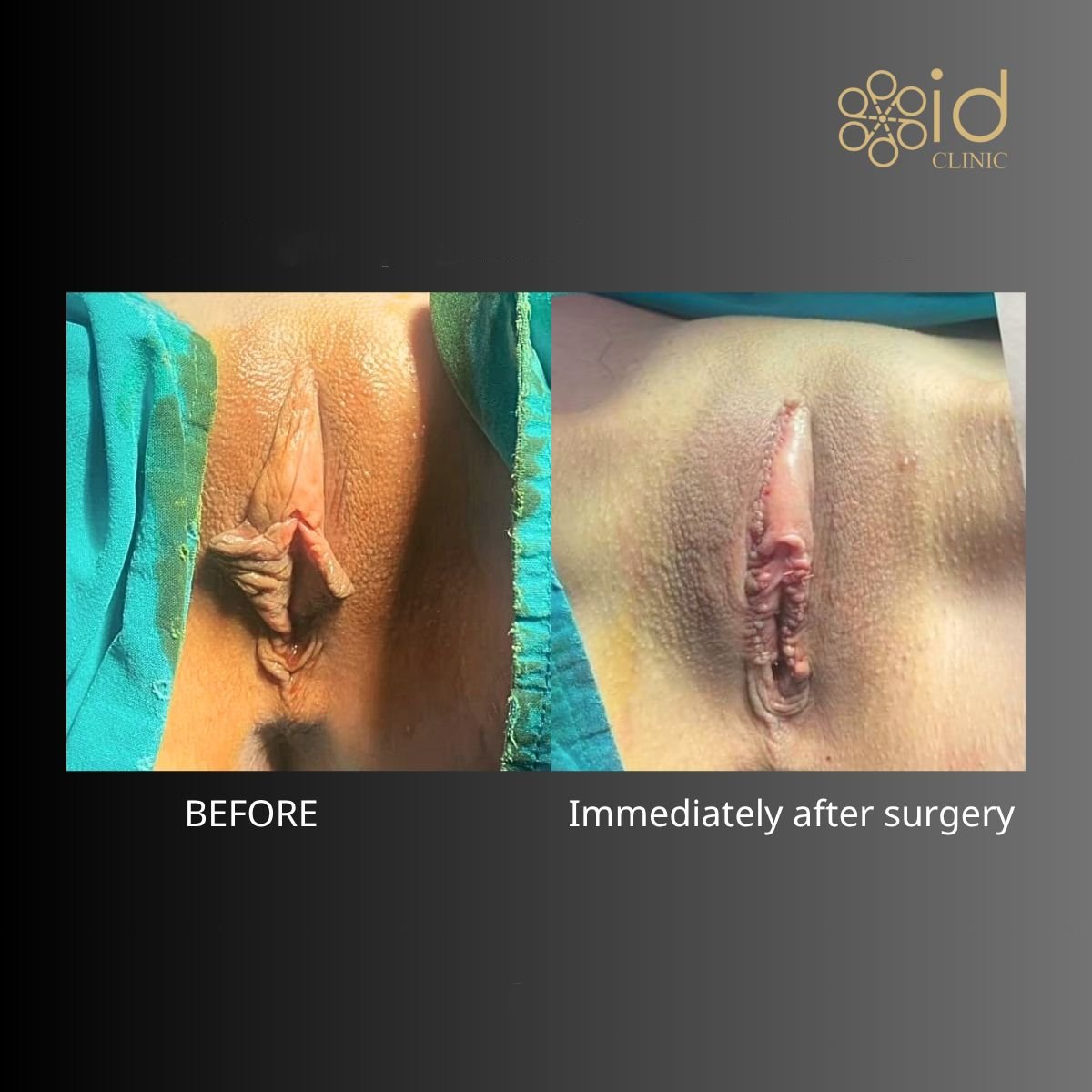 Before and after labiaplasty results at ID Clinic Bangkok, improved labia contour visible