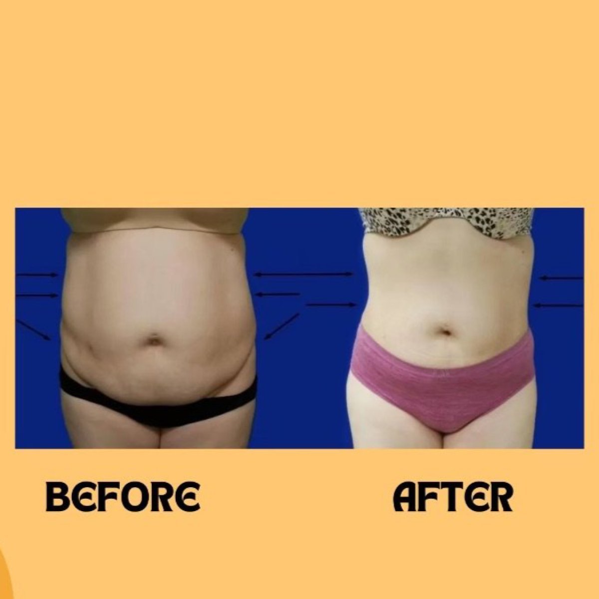Before and after abdominal liposuction results at ID Clinic Bangkok, slimmer waist contour