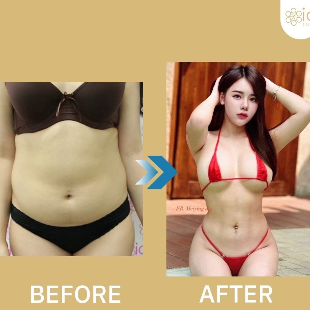 Before and after abdominal liposuction results at ID Clinic Bangkok, slimmer waist contour