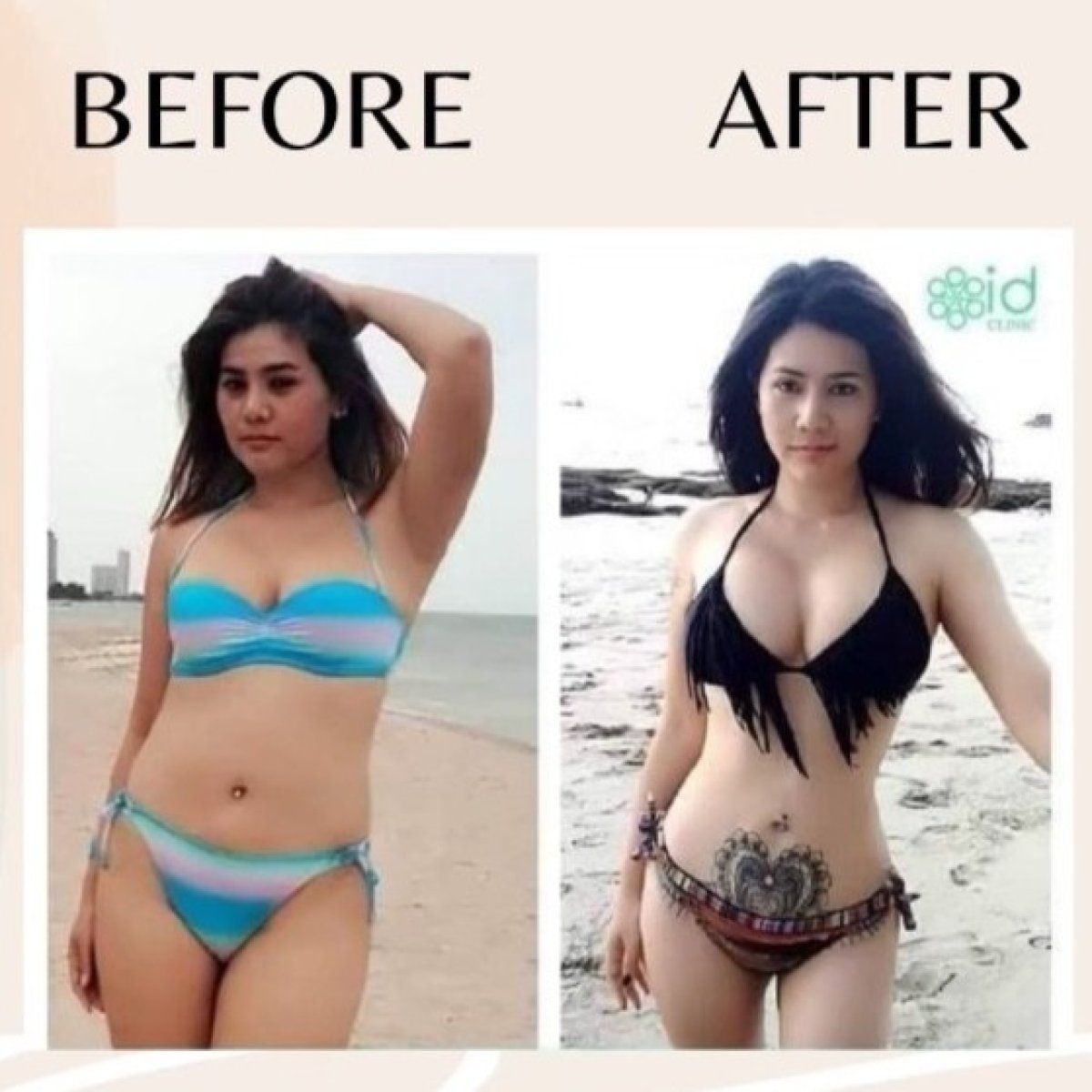 Before and after abdominal liposuction results at ID Clinic Bangkok, improved body contour