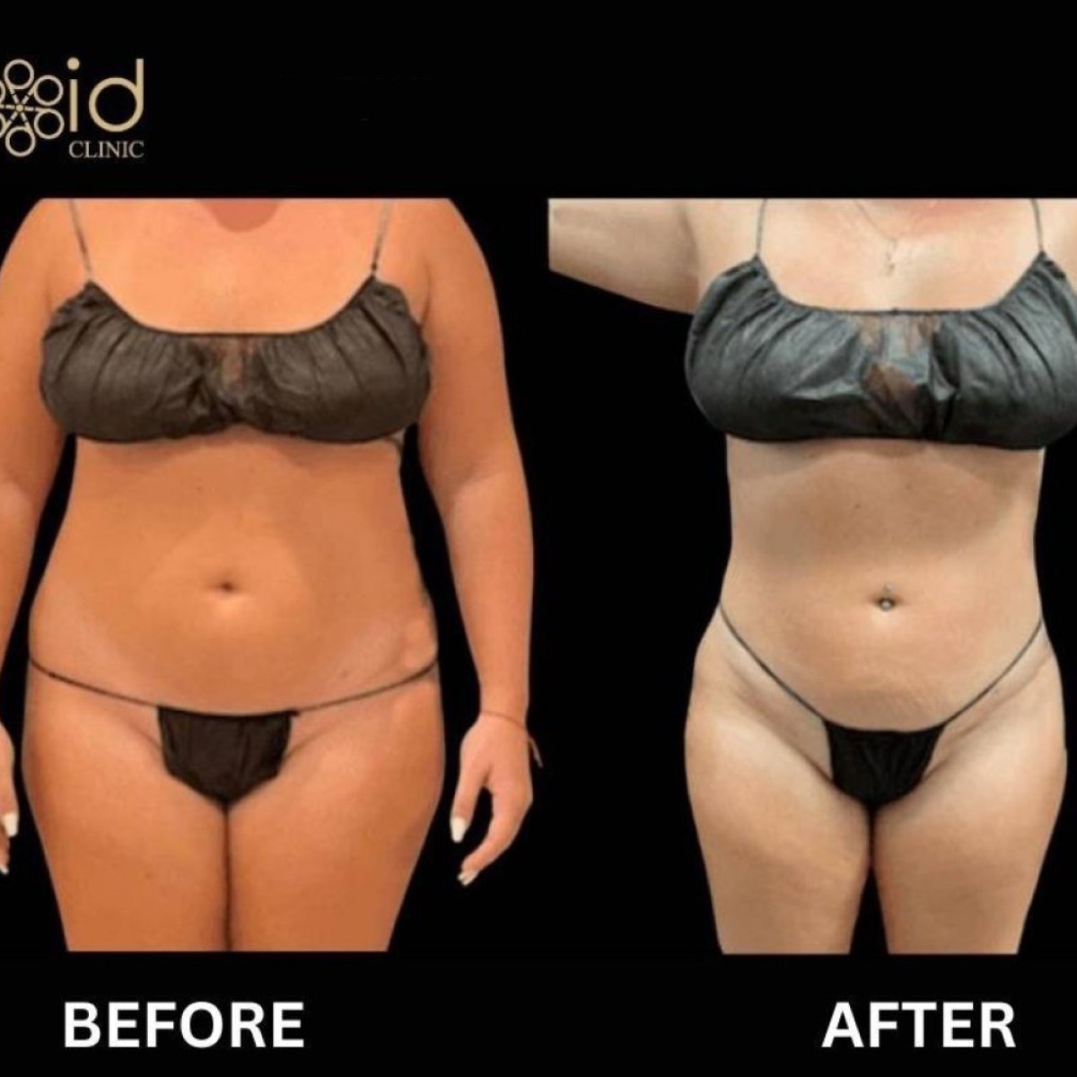 Before and after abdominal liposuction results at ID Clinic Bangkok, improved body contour