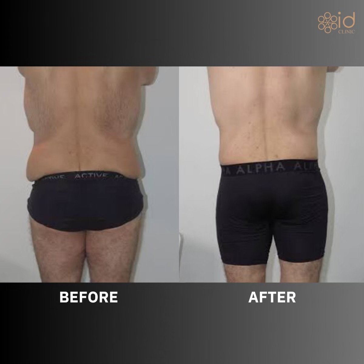 Before and after liposuction results at ID Clinic Bangkok, visible waist contour improvement