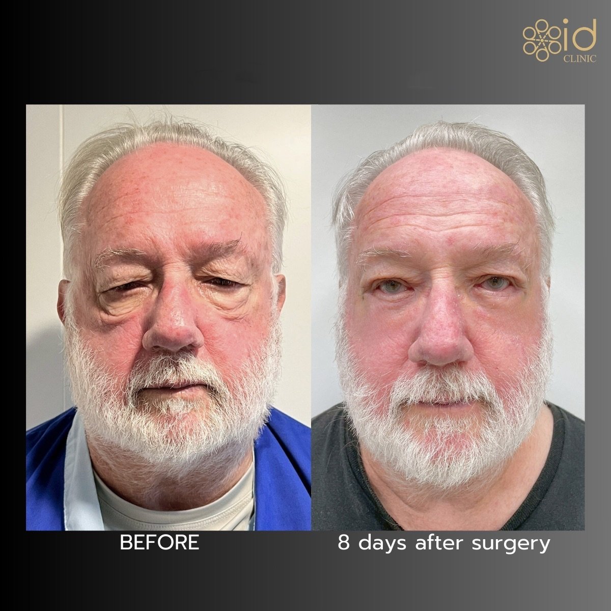 Before and after upper and lower eyelid surgery results at ID Clinic Bangkok, 8 days post-op