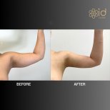 Ergebnisse der Vaser-Fettabsaugung durch Dr. Dr Phatcharasak Kraisornphongsakul Md — Vorher- und Nachher-Fotos des Patienten Fotos vor und nach Vaser-Fettabsaugung durch Dr. Dr Phatcharasak Kraisornphongsakul Md