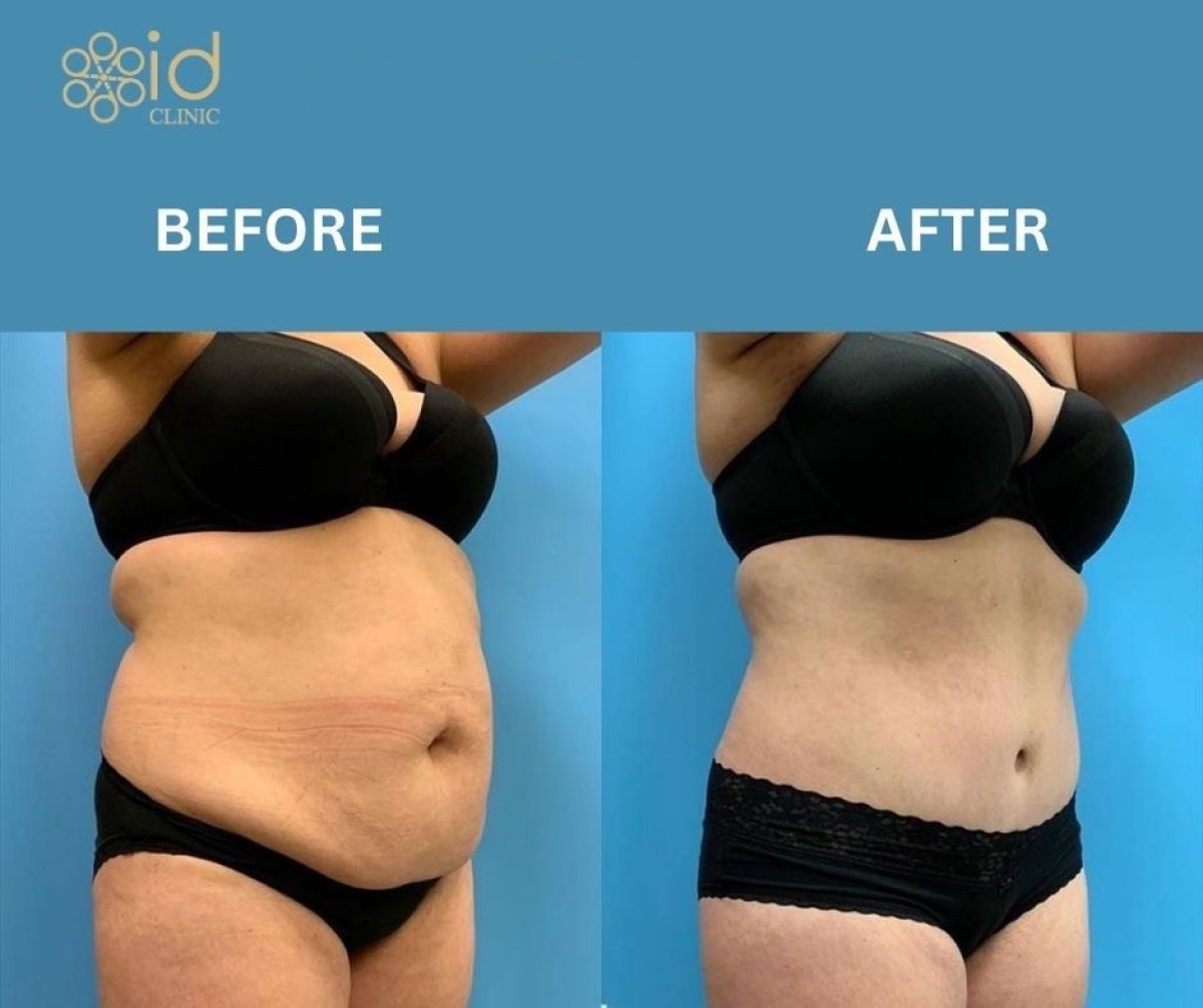 Before and after Vaser liposuction results at ID Clinic Bangkok, improved abdominal contour