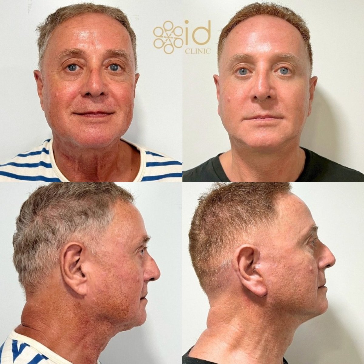 Before and after deep plane facelift results at ID Clinic Bangkok, visible facial rejuvenation