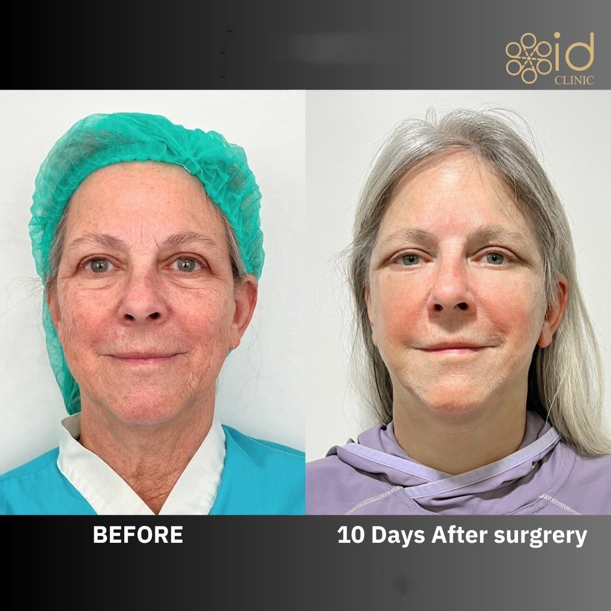 Before and after brow lift results at ID Clinic Bangkok, visible forehead and eye area rejuvenation