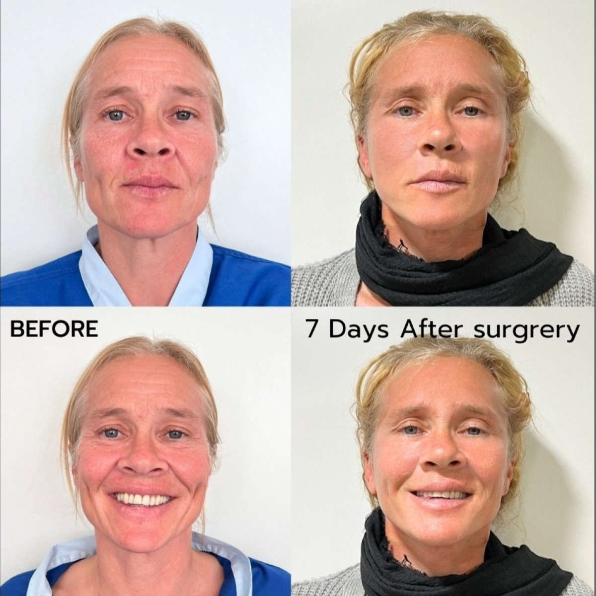 Before and after brow lift results at ID Clinic Bangkok, visible facial rejuvenation after 7 days