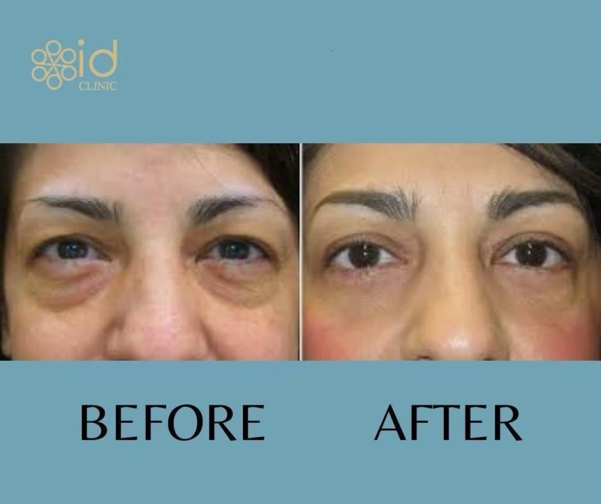 Before and after upper eyelid surgery results at ID Clinic Bangkok, reduced eyelid puffiness