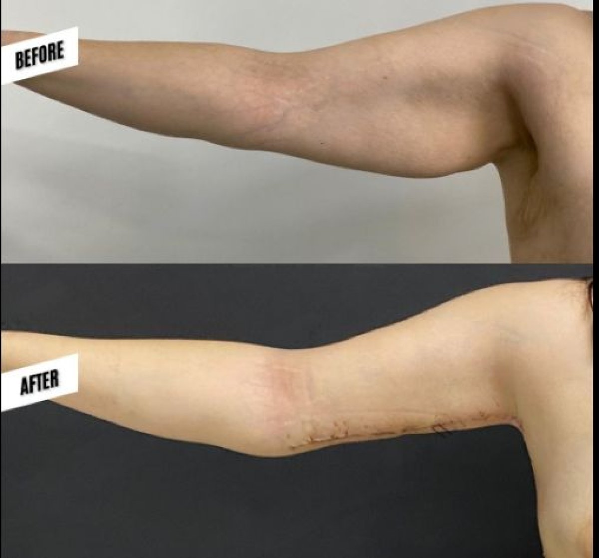 Before and after arm liposuction results at Hisar Hospital Intercontinental, improved contour