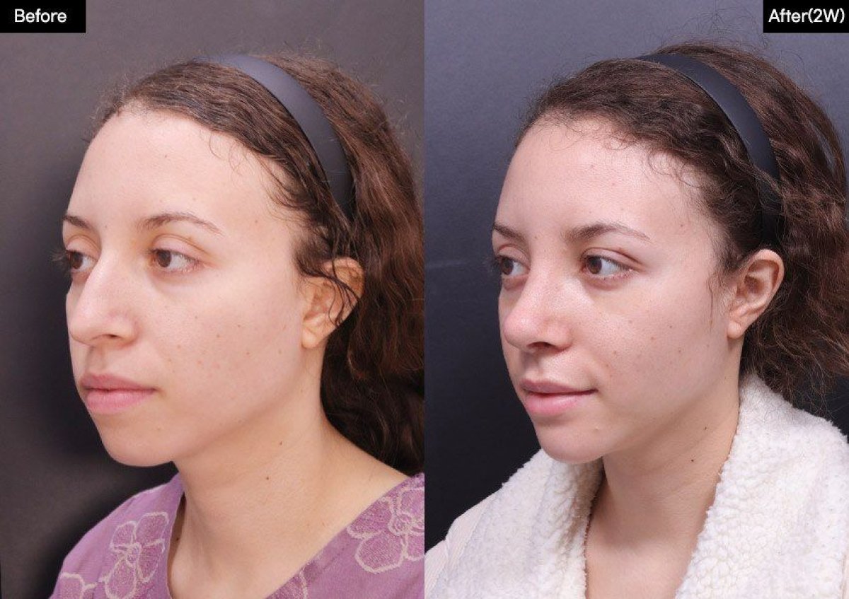 Resultados antes y después de implante de mentón en VG Plastic Surgery – contorno mejorado